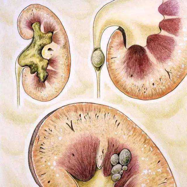 肾结石有哪些症状