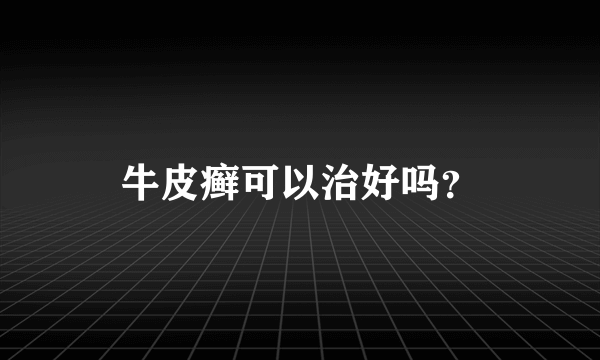 牛皮癣可以治好吗？