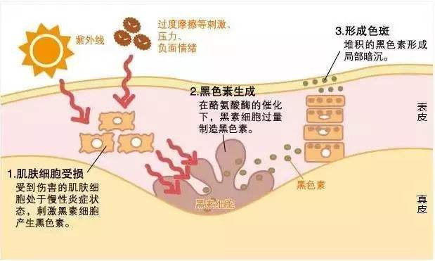 怎样去掉脸上斑点。