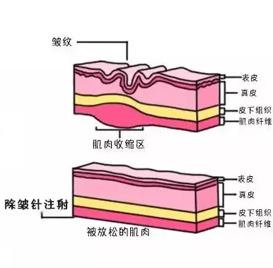 北京注射BOTOX后多久看见除皱效果