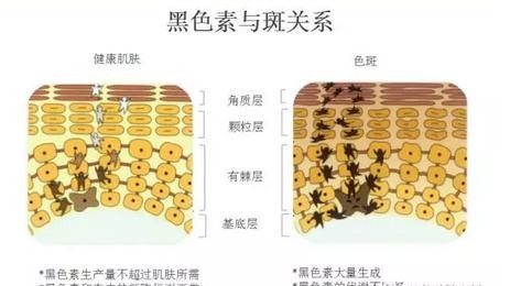 怎样去掉脸上斑点。