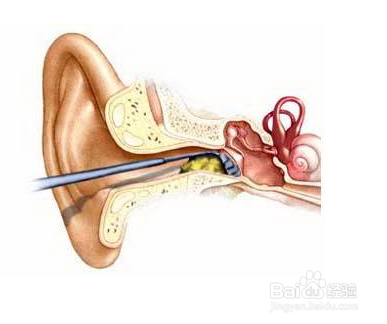 耳朵有耵聍怎么办？