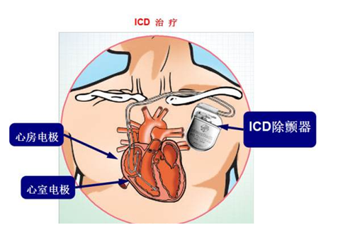 心脏除颤器的作用究竟是什么？