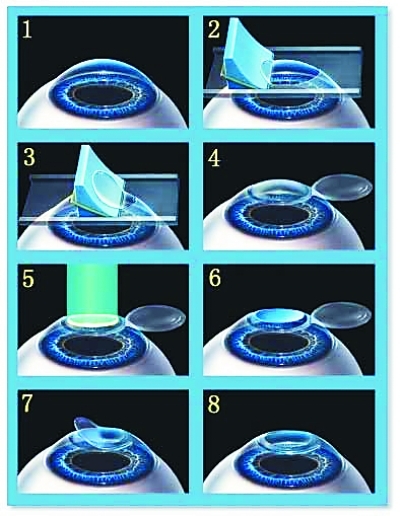 lasik手术的原理