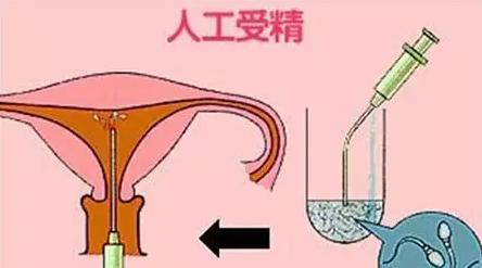 人工授精需要多少钱？