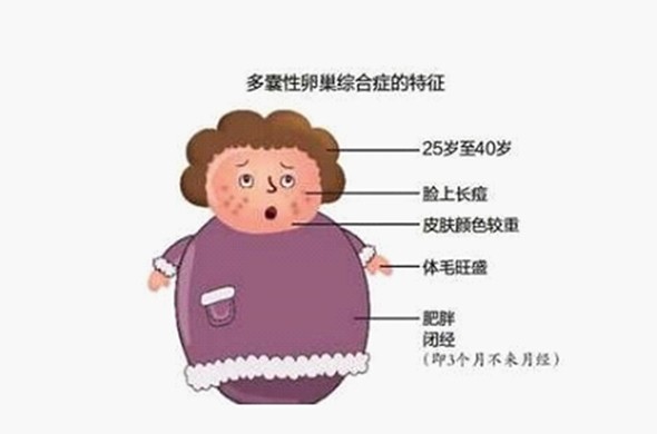 多囊卵巢综合症是什么意思