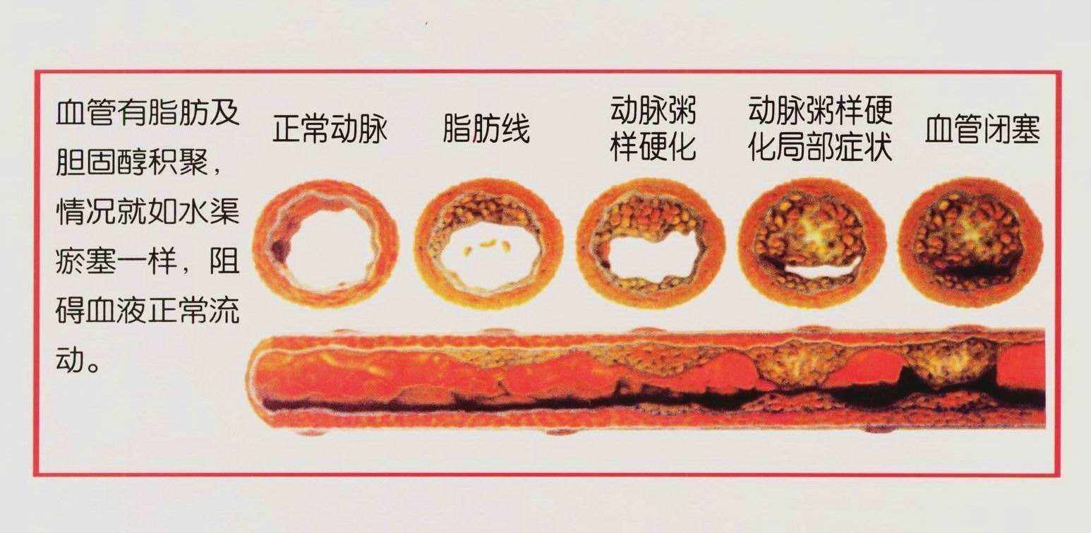 动脉硬化有哪些症状？