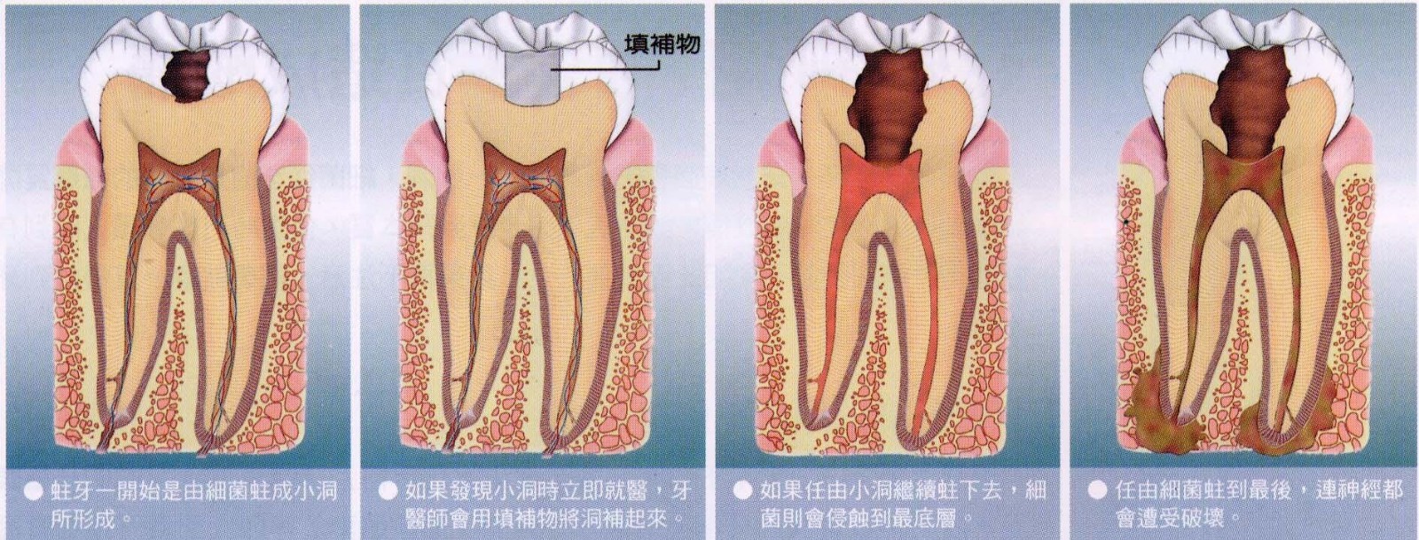 龋齿图片，