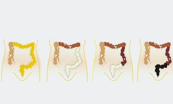 拉屎太臭是什么原因